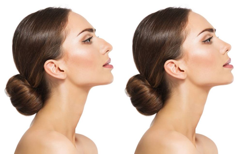 Best Rhinoplasty Surgeon